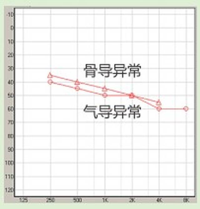 听力曲线:骨导异常,气导异常,气导值—骨导值≤10 dbhl 病变原因