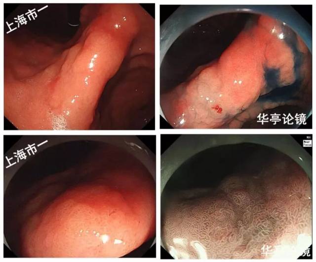 4个精彩病例,带你了解早期胃癌(有图有真相)