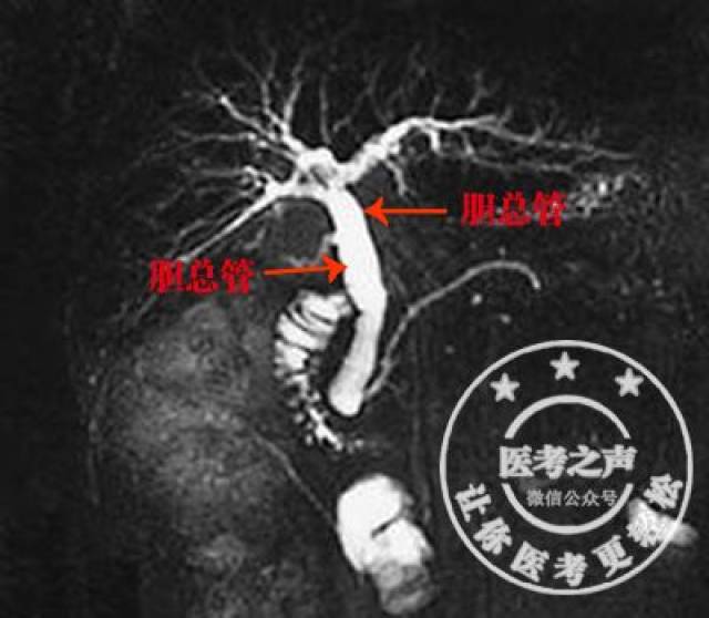 探头装在内镜上 插入胃,十二指肠附近探测胆管 可显示胆管全程 mrcp