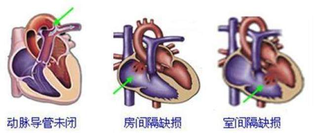什么是心脏杂音 4e8b47303cf44496972132b6b3f96c36.jpeg