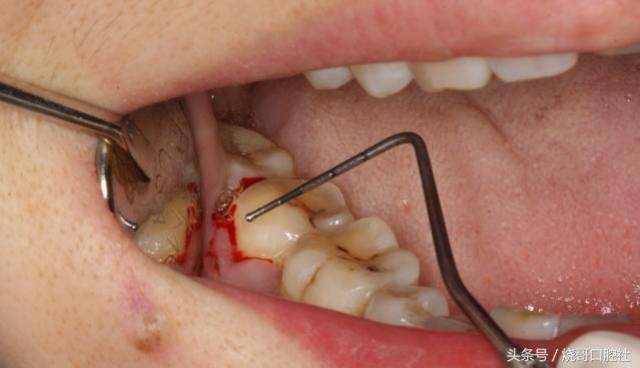 龈下刮治一次性就能解决牙周问题吗?
