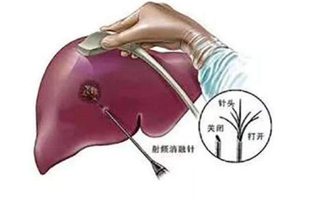 检查出肝血管瘤该怎么办?实例告诉你应该如何选择性治疗