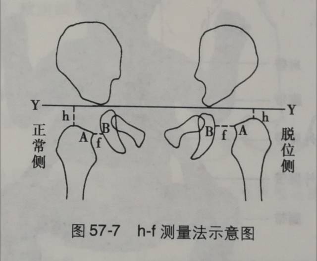 另外,还 可观察到股骨头骨化中心较键侧小,患侧股骨颈前倾角增大,正