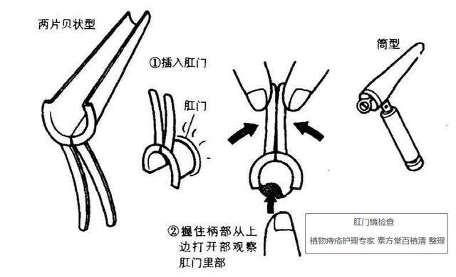 「痔疮检查」肛门镜检查痛苦吗?都查些啥?收藏备用!转发分享!