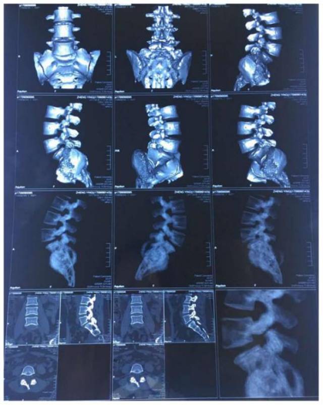 也就是是由于腰部突然受力等原因导致左右两侧的椎弓峡部都断裂,但是