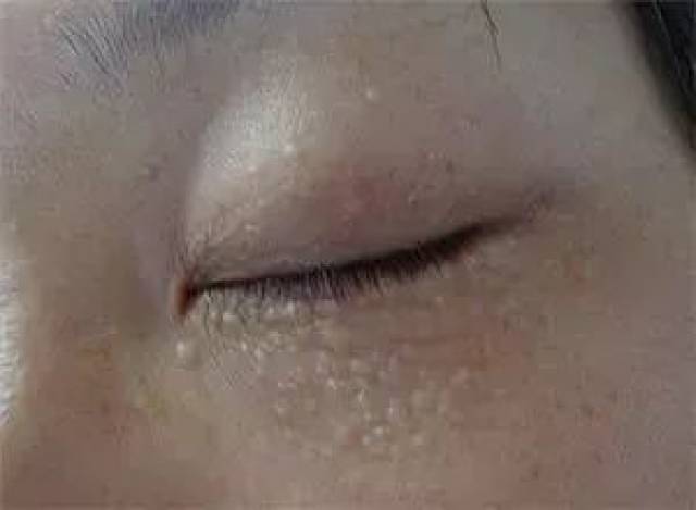 眼周出现的小疙瘩,通常可能是粟丘疹或汗管瘤.