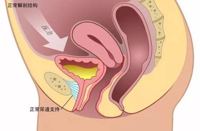 遗传因素与压力性尿失禁有较明确的相关性,这点主要在天生的弹性组织