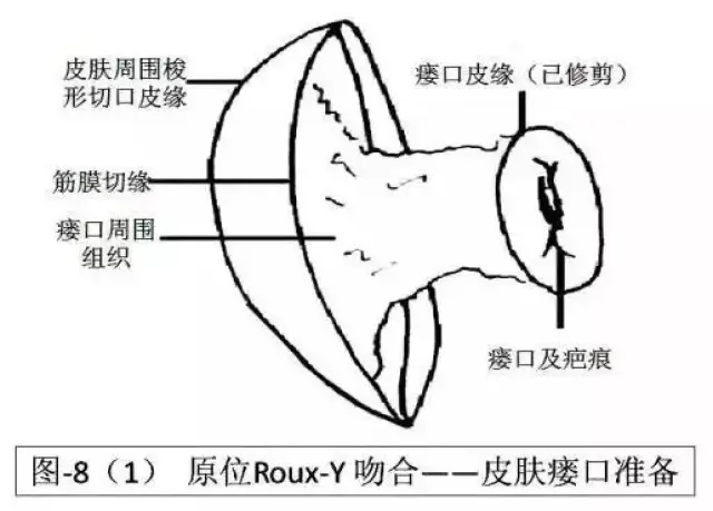 上腹部手术后慢性窦道的处理经验