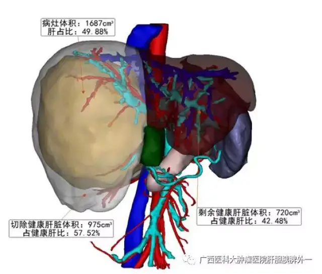 广西医科大学附属肿瘤医院肝胆一区借助三维影像重建及残肝体积测算为