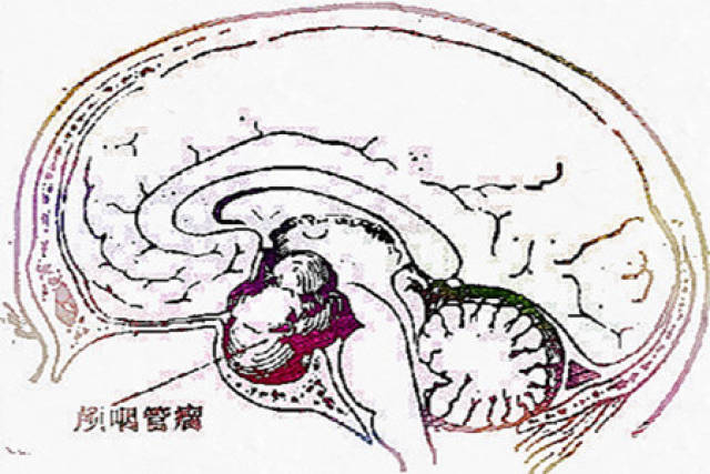 颅咽管瘤手术后出院要注意的几件事