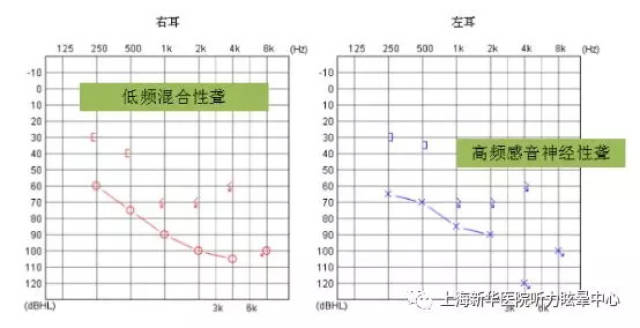 部分患儿低中频区听力较好情况下500hz和1000hz频率可引出声反射,说明