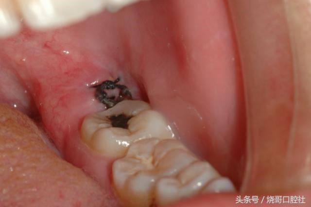 还有拔牙后牙槽窝不一定得缝上线,有些手术后创口小的靠血凝块就能