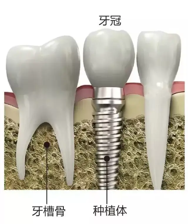 种植牙之所以贵,主要是因为它的人工牙根是用金属钛制造成的,而钛是