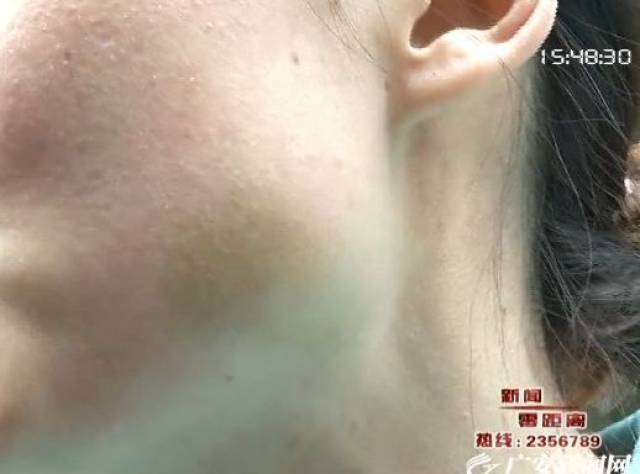 在黄女士的身上,被家暴后的伤痕依然清晰可见.