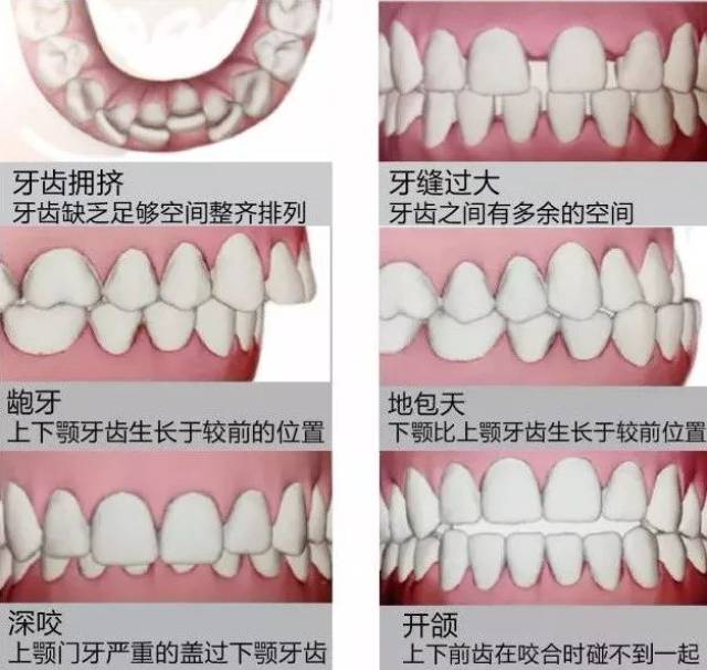 和传统牙齿矫正有什么不同?