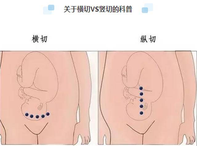 剖腹产横切好还是竖切好呢?想要二胎的话应该怎么选择呢?