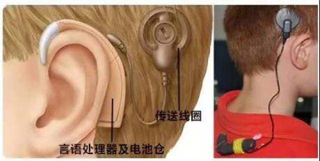 人工耳蜗到底是什么东西?