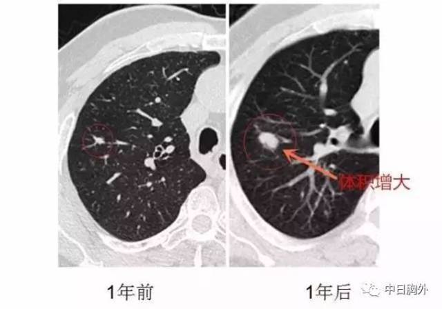 多年医疗实践总结告诉大家:发现肺小结节莫惊慌害怕