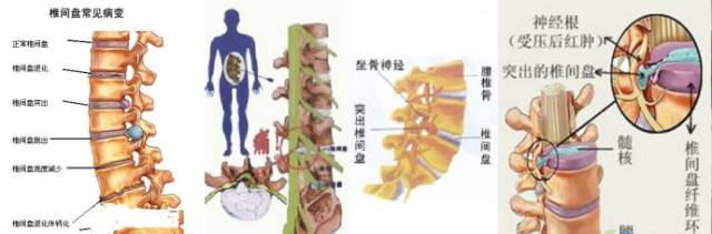 45         注:腰椎间盘突出症无效者12例中,伴有椎管狭窄者10例.