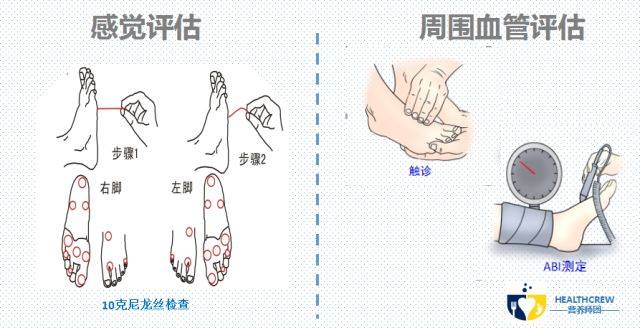 【营养师团】糖尿病足,让你痛而不觉的悲哀