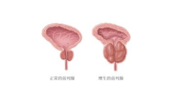 新技术治疗前列腺肥大