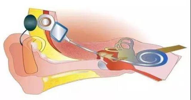2,人工耳蜗的工作原理: 手术将植入体接收线圈植入颞骨乳突内,将电极