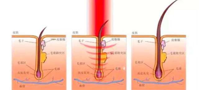 因为它的原理是让激光能促进头皮的血液循环,疏通长久被堵塞的毛囊