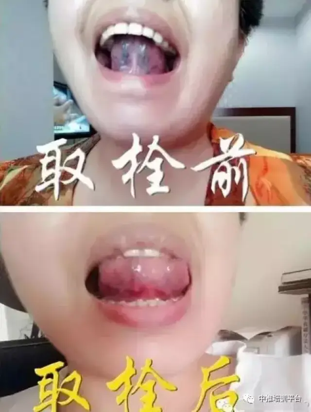 舌下取栓——重启生命之脉-健康频道-手机搜狐