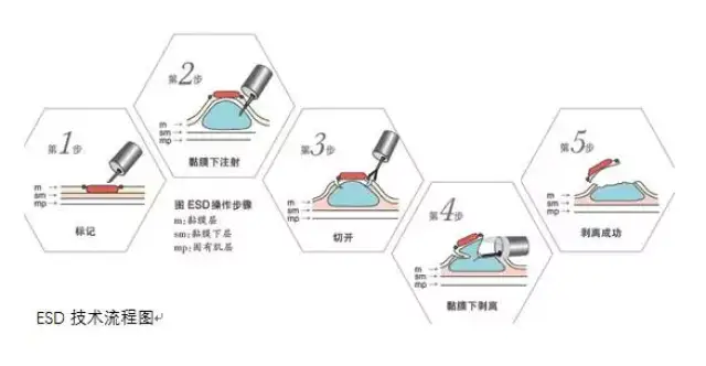 早诊早治食管癌"镜子"功不可没