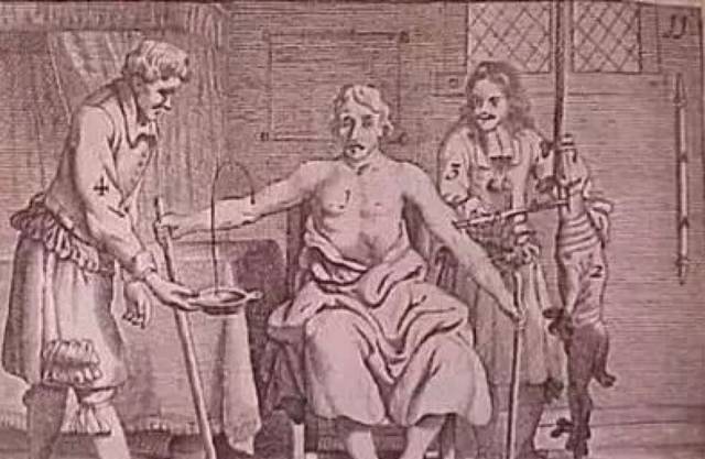 清除铁离子竟逆转心衰,原来是患有一种需要放血治疗的病