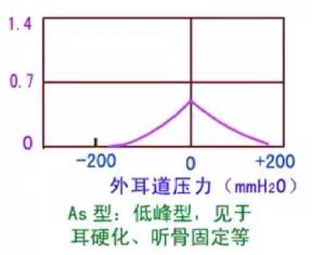 声导抗中的鼓室图