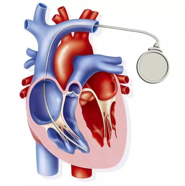 装了心脏起搏器,为啥还能做核磁共振?