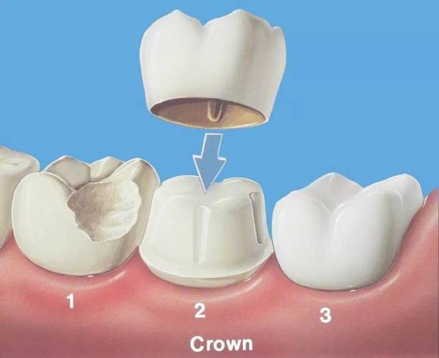 牙冠,是目前修复牙体缺损的终极手段,适用于大面积的破损,龋坏牙齿