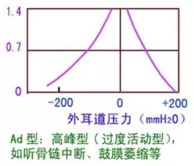 声导抗中的鼓室图