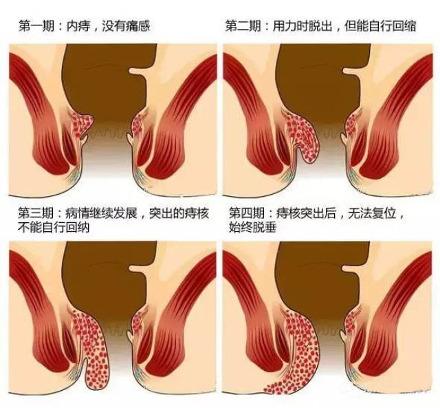 如能回纳,请在每次脱出后手动回纳;据不完全统计,成年人类的平均痔疮