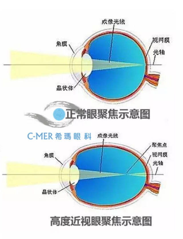 高度近视引发的危害多,保护眼睛刻不容缓