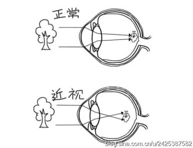 近视:近视是人眼看到的物体成像在视网膜的前段.