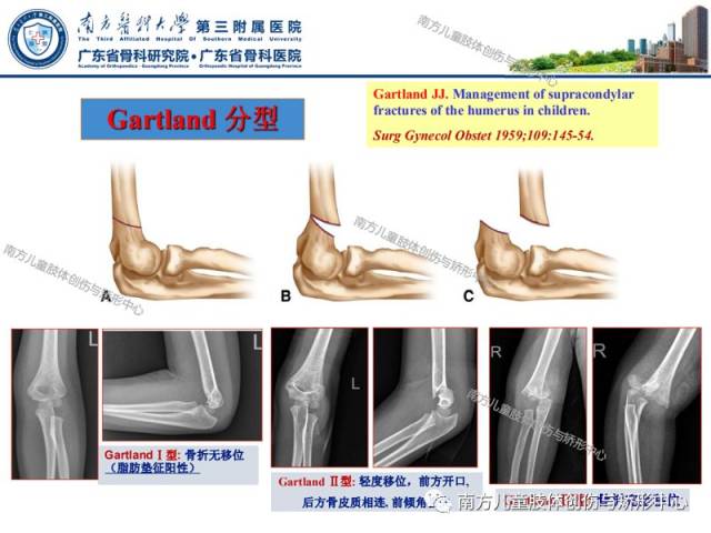 小儿肱骨髁上骨折的治疗策略