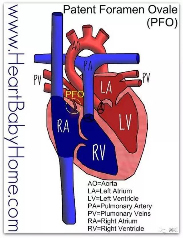 卵圆孔未闭合 (patent foramen ovale)简称pfo,属于先天性心脏缺陷的