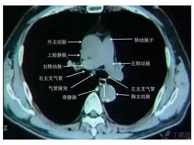 注:最后两张彩图是胸腔的血管图,所以看不到颈内静脉和锁骨下静脉汇