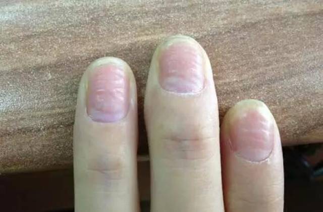 指甲表面凹凸不平是因为它!