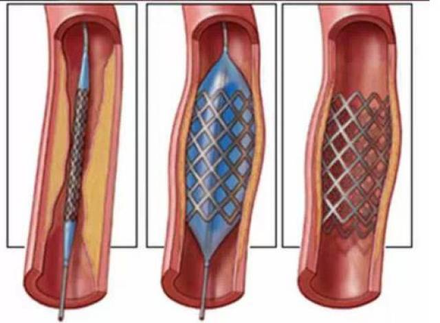 心脏支架是选择进口还是国产,听听心内科医生怎么说!