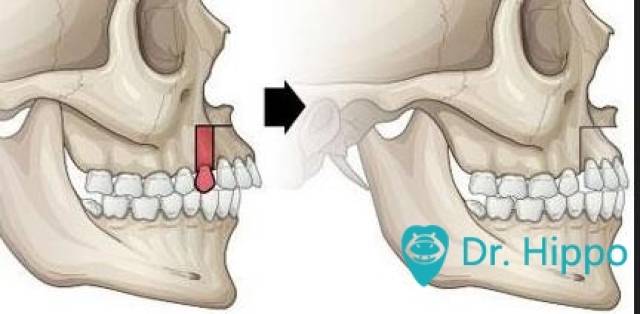 牙槽骨突出怎么办?