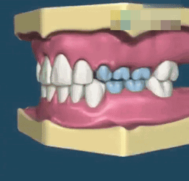 总说乳牙会换掉,龋齿也没关系;乳牙不齐没关系啊,换牙之后整齐就好了
