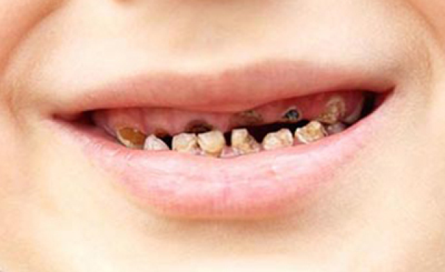 到底是什么原因导致了孩子蛀牙呢?有哪些危害?