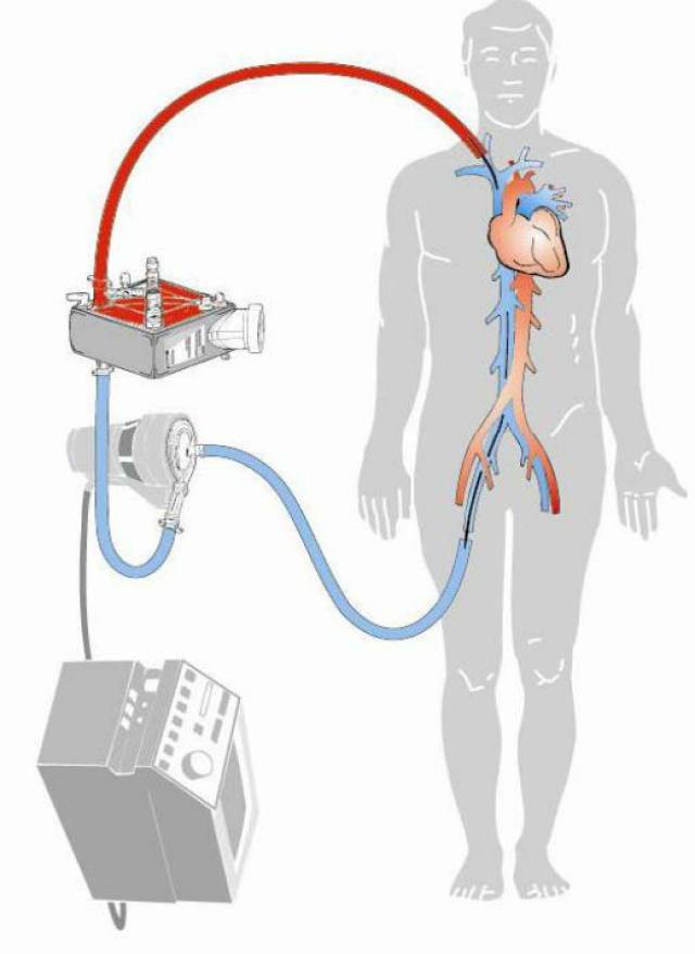 医学新知 | 神奇的"魔肺(ecmo)"让生命重新绽放