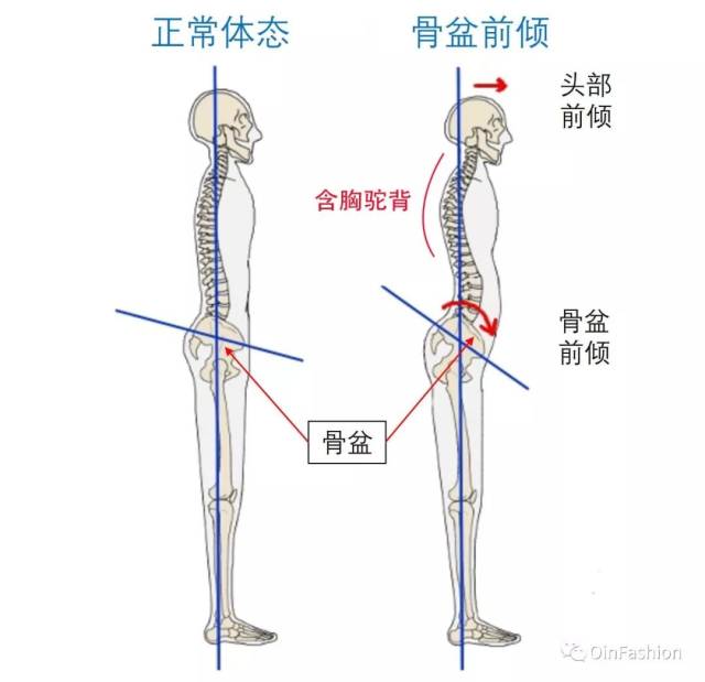 闭合不全的骨盆会牵拉腰部周围的肌肉向左右扩张,使得腰部神经受到