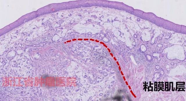 esd术后病理:(食管)中-低分化粘液腺癌,位于粘膜固有层至粘膜下层