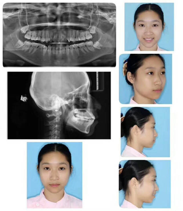 南宁天使口腔姐妹花戴牙套"毕业"啦!