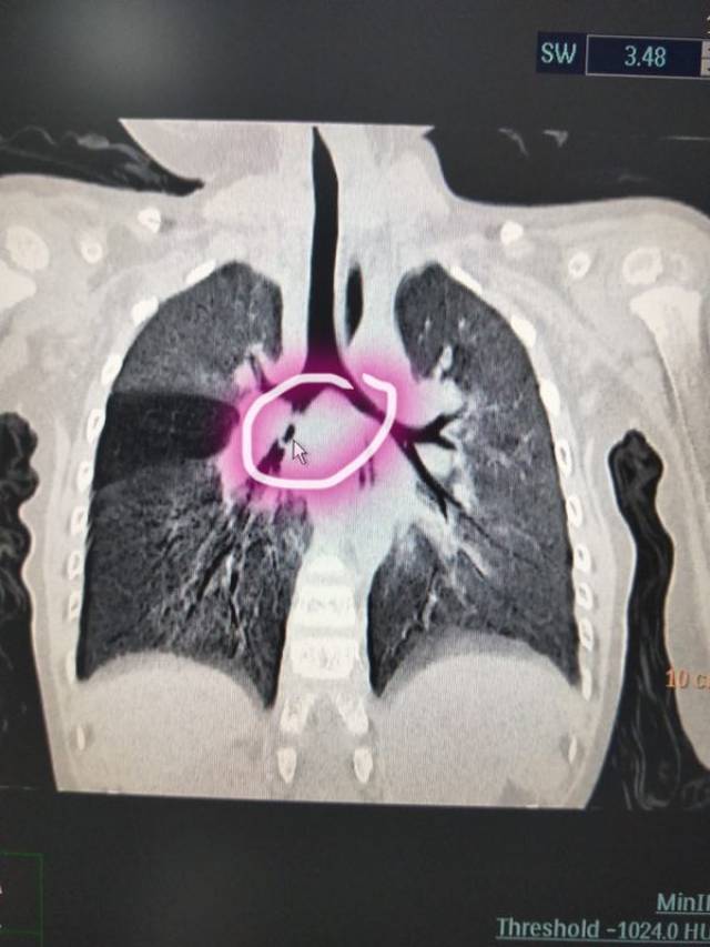 经胸部ct和气道三维重建检查,结果也提示有异物,我们建议做气管